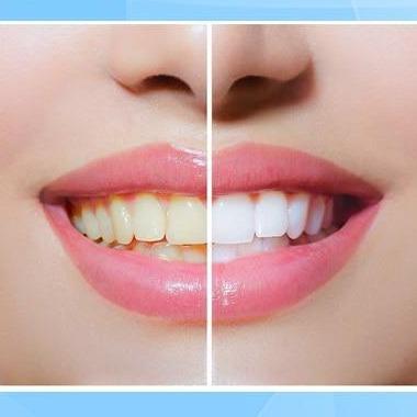 【🔥 Buy 1 Get 1 Free】 Teeth Whitening Pen