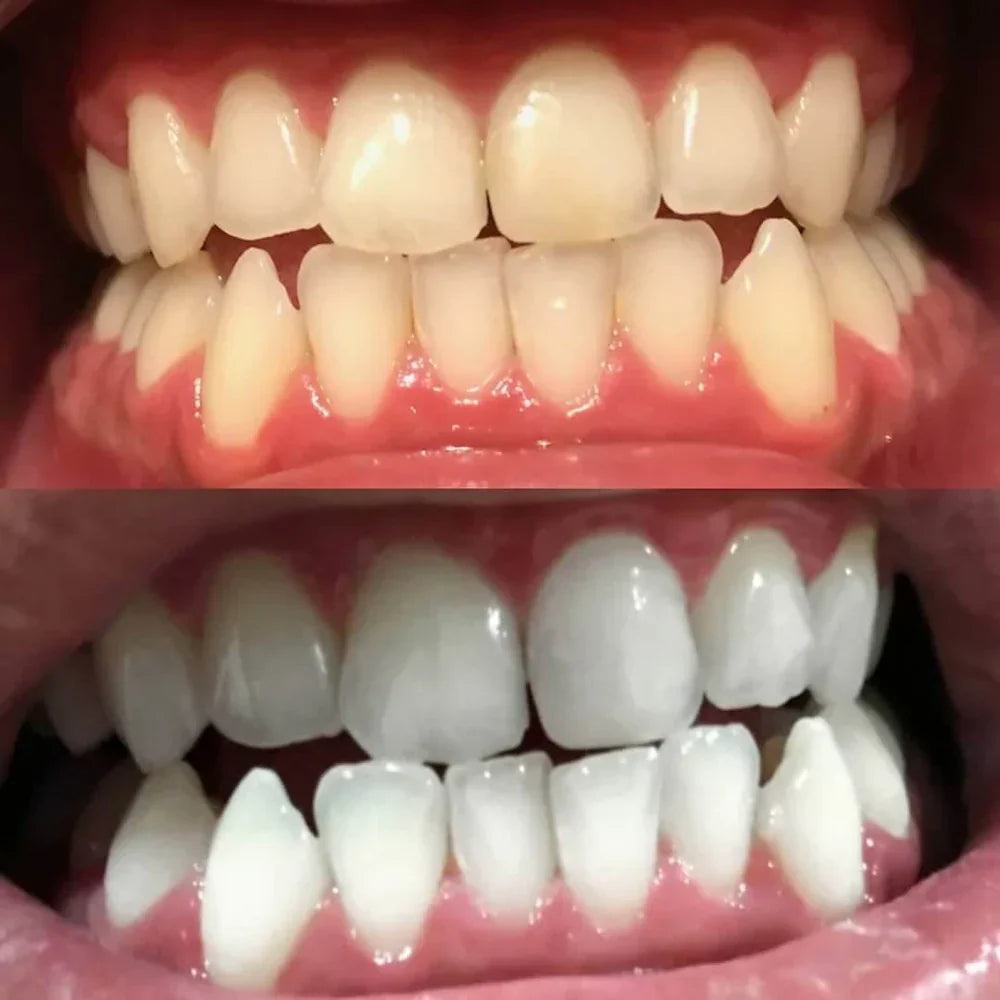 BrightBeam™ Whitening Pen – Un Sourire Éclatant en 10 Minutes