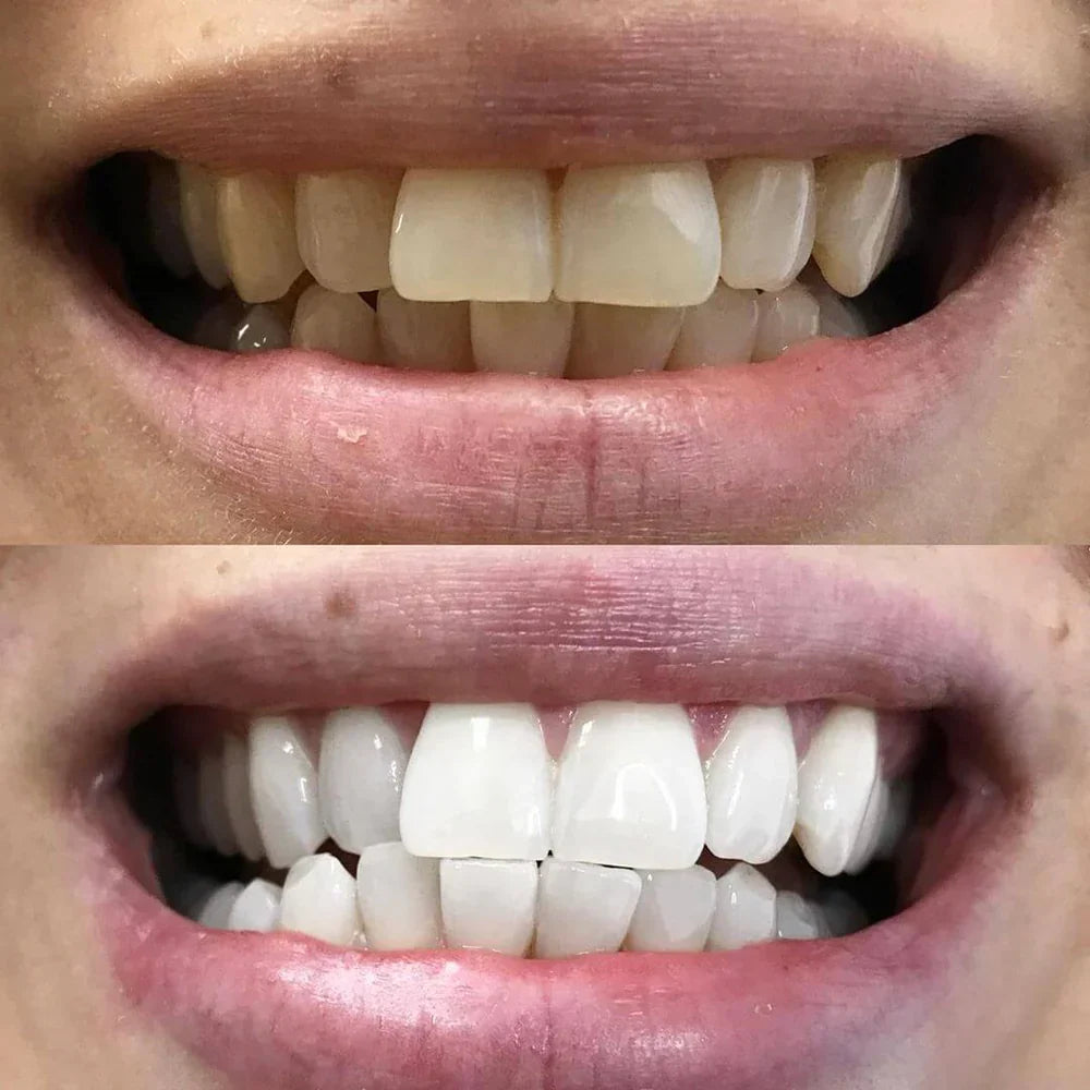 BrightBeam™ Whitening Pen – Un Sourire Éclatant en 10 Minutes