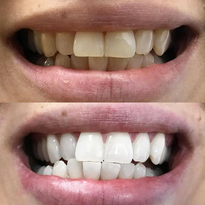 BrightBeam™ Whitening Pen – Un Sourire Éclatant en 10 Minutes