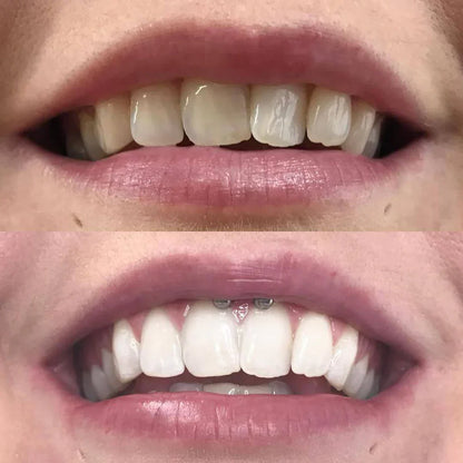 BrightBeam™ Whitening Pen – Un Sourire Éclatant en 10 Minutes