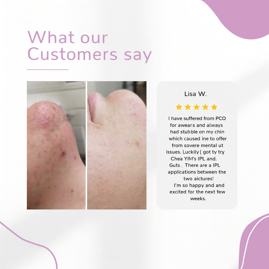 ✨ Ylvis IPL Hair Remover – Smooth, Hair-Free Skin from Home