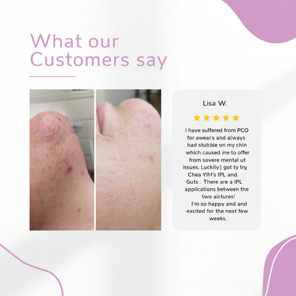 ✨ Ylvis IPL Hair Remover – Smooth, Hair-Free Skin from Home